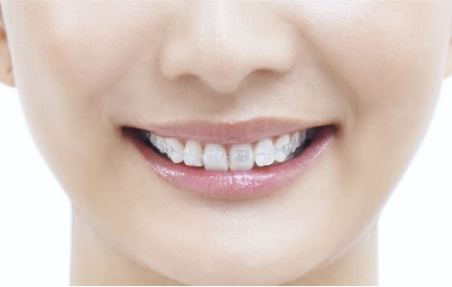 クリアブラケット