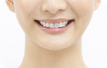 ブラケット矯正