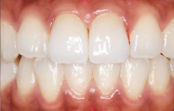 ジルコニアボンド