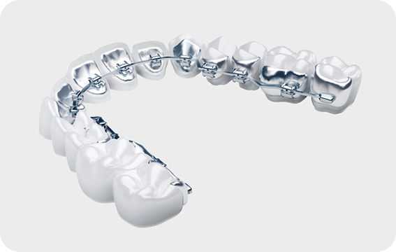 舌側矯正（裏側矯正）